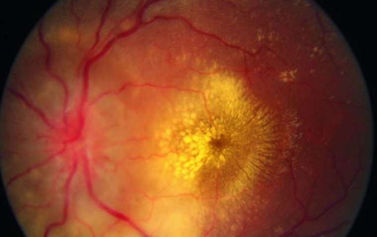 Hypertensive Retinopathy: Causes, Symptoms, and Treatment