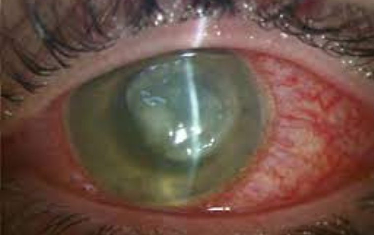 Infectious Keratitis: Causes, Treatment, and Prevention Guide