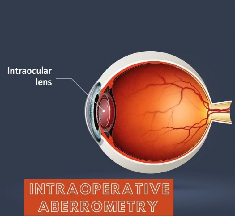 Intraoperative Aberrometry – Cataract Surgery & IOL Selection 