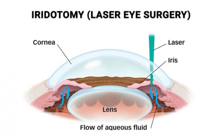 Iridotomy: Understanding the Procedure, Benefits, and Recovery