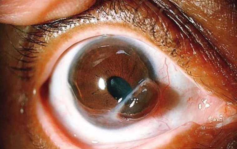 Iris Prolapse: A Comprehensive Review of Causes, Diagnosis, and Management 