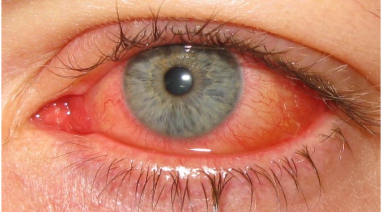 Keratoconjunctivitis: Symptoms, Causes, and Treatment Options