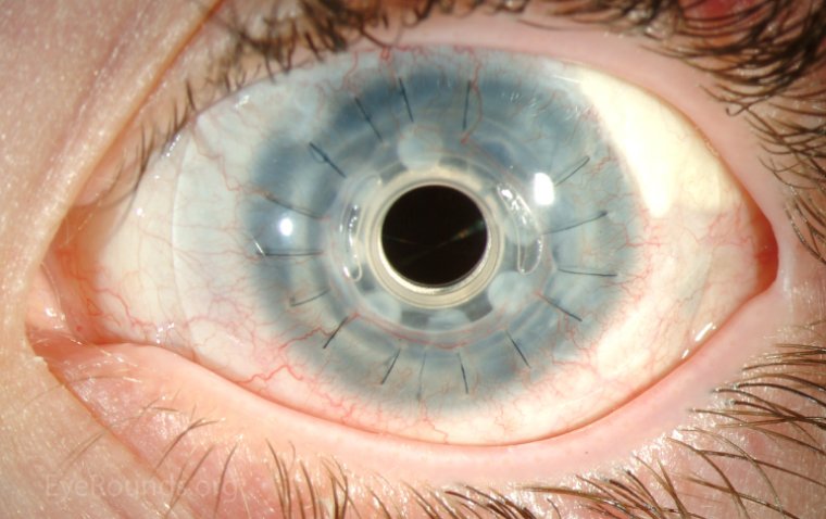 Keratoprosthesis: A Comprehensive Guide to Artificial Cornea Implants