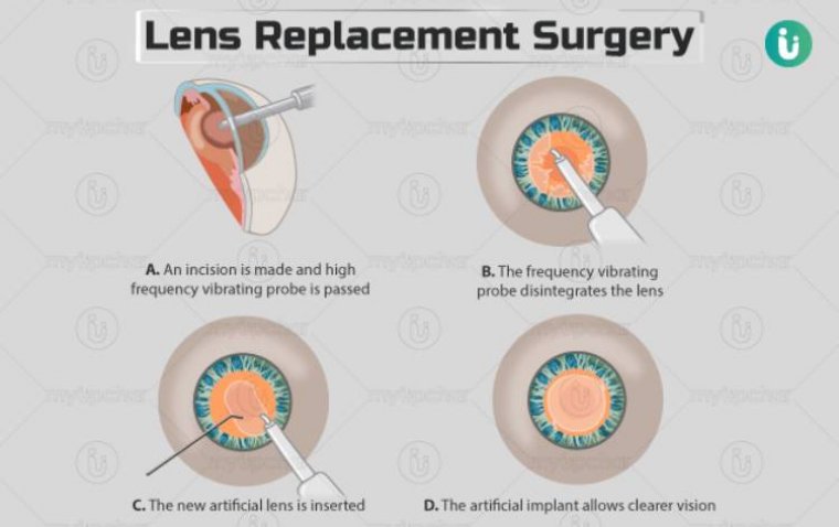 Lens Replacement Surgery: What to Expect from Start to Finish 