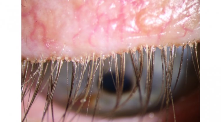 Lotilaner Ophthalmic Solution Proven Effective for Treating Demodex Blepharitis