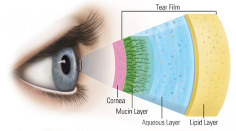 Meibomian Gland Dysfunction: More Than Just Dry Eyes