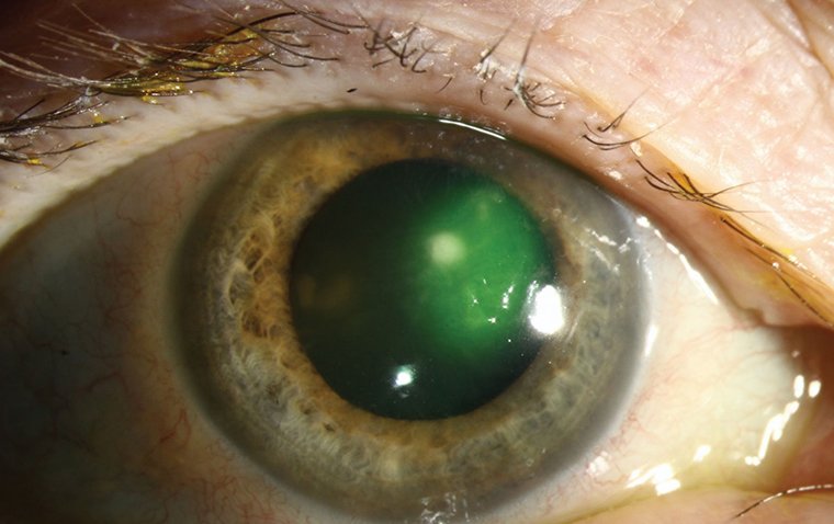 Microbial Keratitis (MK)