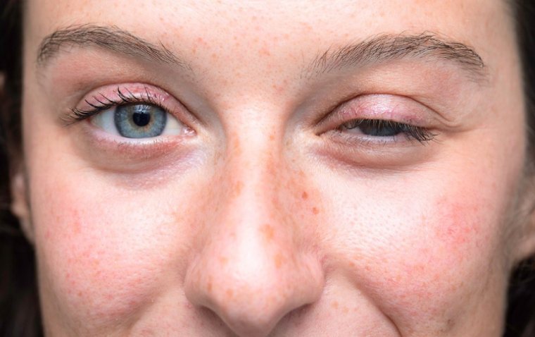 Myasthenia Gravis Ptosis: A Closer Look at the Eye Symptom