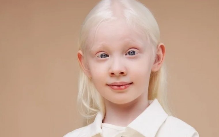 New Study Reveals Why Albinism Causes Poor Vision 