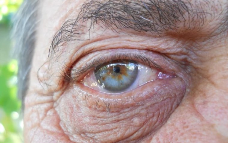 Novel Compound Could Potentially Replace Injections for Wet AMD Treatment 