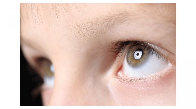 Nystagmus Causes, Symptoms and Treatments 