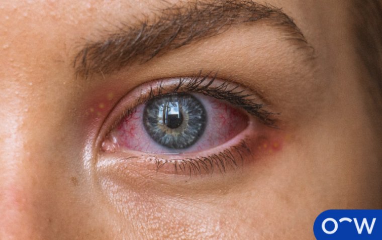 Ocular Herpes: A Closer Look at Recurrent Eye Infections