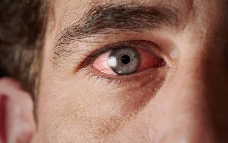 Ocular Inflammation: Types, Causes, Diagnosis, and Treatment