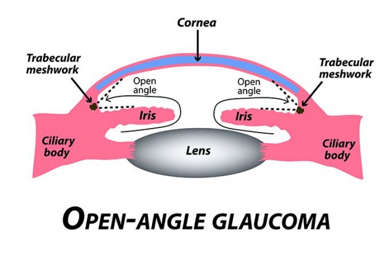 Open-Angle Glaucoma Treatment 