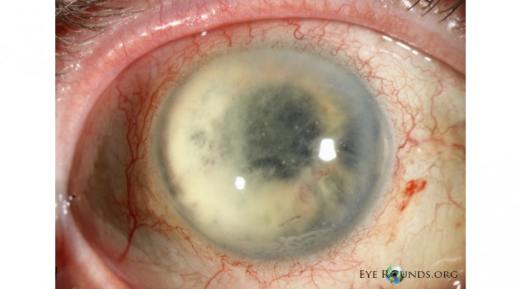 Ophthalmologists Report a Fungal Endophthalmitis Outbreak After Cataract Surgery in S. Korea 