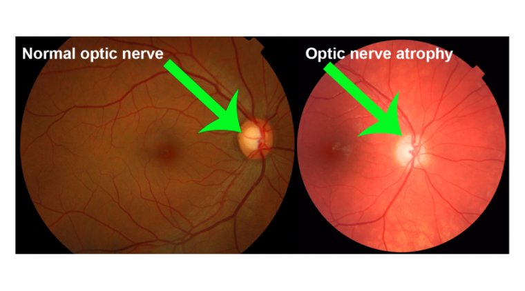 Impaired Vision What Is Optic Atrophy OBN