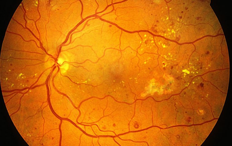 Oral Drug Blocks Retinal Capillary Stiffening, Offering Hope for DR Prevention