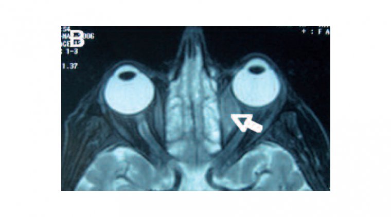 Myasthenia Gravis Ptosis And Its Management OBN