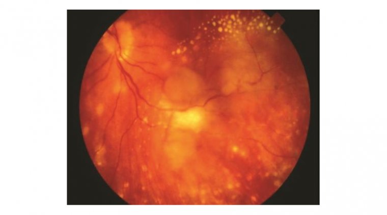 Panuveitis: A Rare but Serious Eye Inflammation