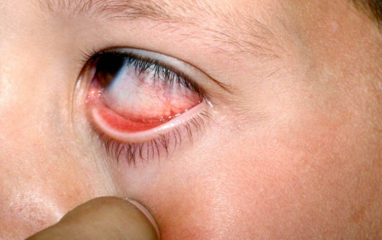 Parinaud Oculoglandular Syndrome: A Unique Blend of Ocular and Glandular Symptoms