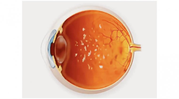 All About Pars Planitis (Intermediate Uveitis)