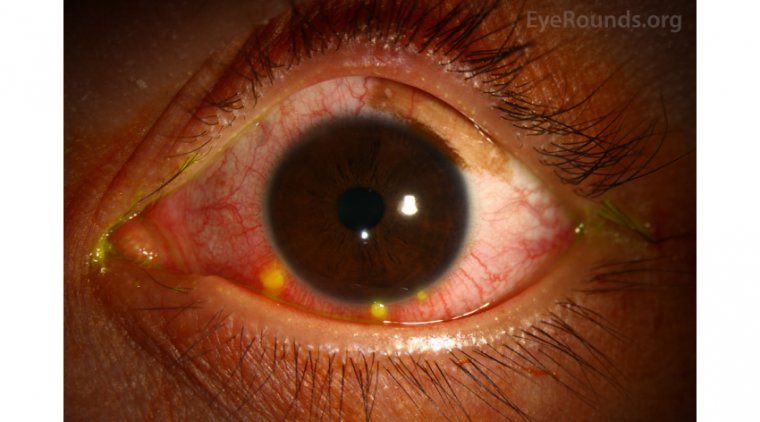 Phlyctenular Conjunctivitis: A Guide to Managing the Condition