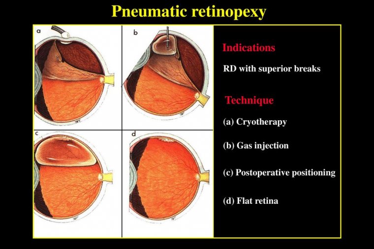 Pneumatic Retinopexy