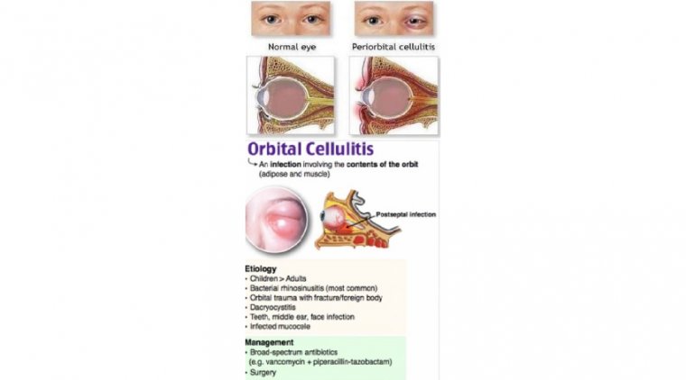 Preseptal and Orbital Cellulitis