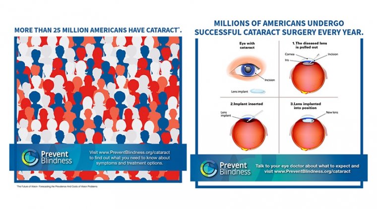 Prevent Blindness Provides Educational Information and Resources on the Cause of Vision Loss for Cataract Awareness Month in June