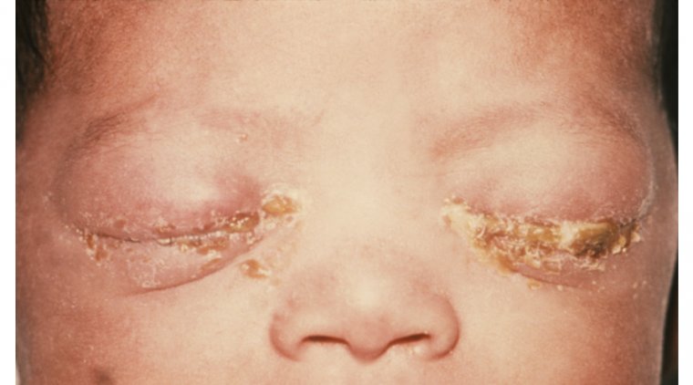Preventing Blindness in Newborns: A Look at Ophthalmia Neonatorum