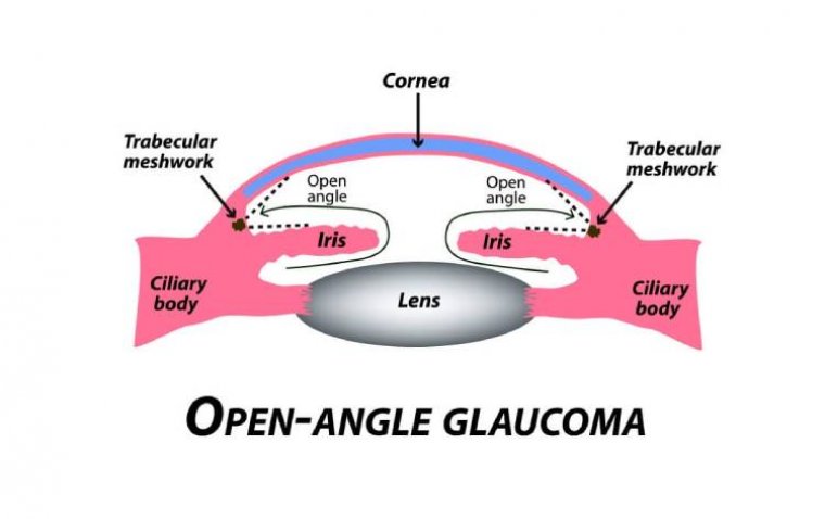 Primary Open Angle Glaucoma (POAG) 