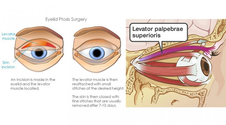 Ptosis Surgery 