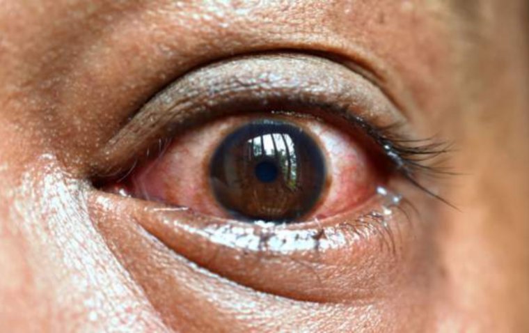 Red Eye Disease Alert in Mombasa: Prevention and Management Measures