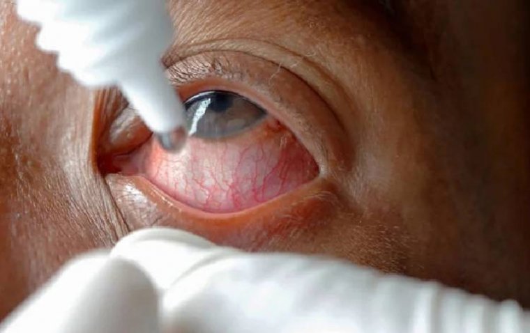 Report Highlights Significant Drug Waste from SUCD for Eye Drops