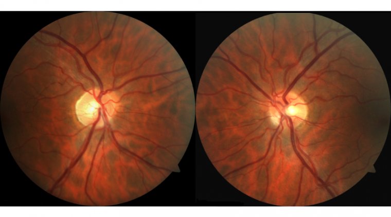 Researchers Develop First Criteria to Diagnose Optic Neuritis