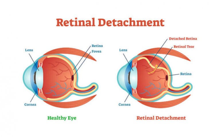 Researchers Develop Minimally Invasive Technique for Retinal Detachment