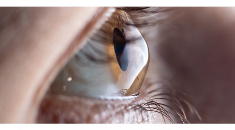 Researchers Discover a Potential Cause for Keratoconus