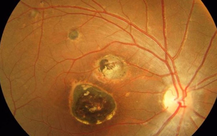 Researchers Unveil the Role of Iron in Ocular Toxoplasmosis