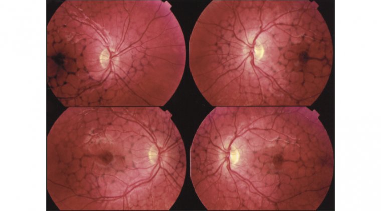Retinal Pattern Dystrophies