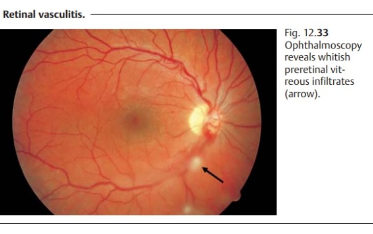 Retinal Vasculitis: A Closer Look at Inflammatory Eye Diseases