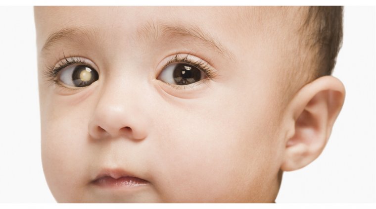 Retinoblastoma: A Rare Type of Eye Cancer Affecting Children 