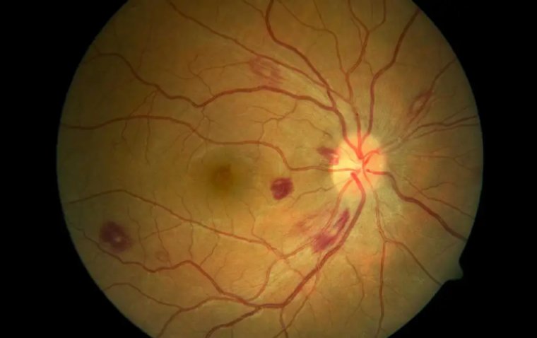 Roth Spots in the Eye: What You Need to Know