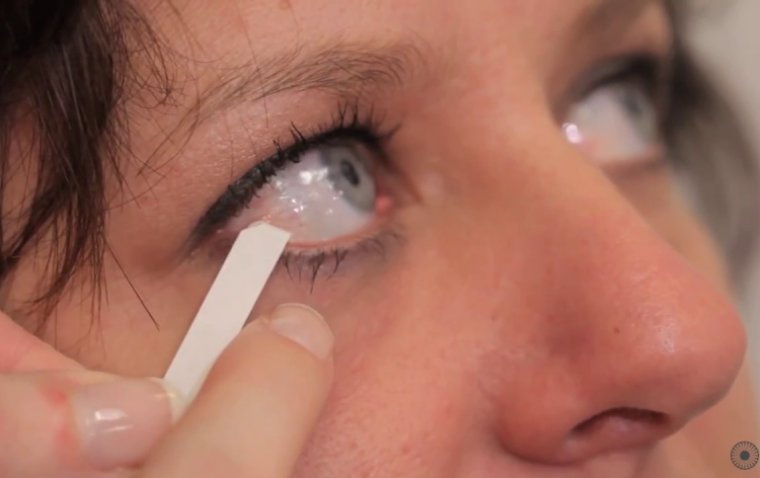 Schirmer's Test and Its Implications in Monitoring and Managing Dry Eyes