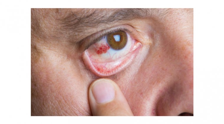 Scleritis: A Rare But Blinding Eye Disease  