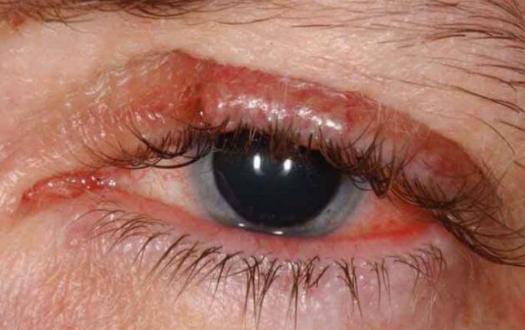 Sebaceous Gland Carcinoma: Ocular Manifestations and Management