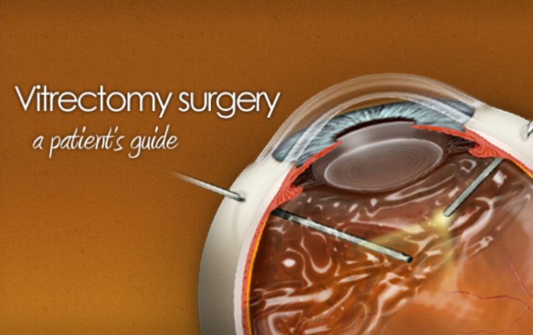 Seeing Clearly Again: Vitrectomy Surgery for Floaters 