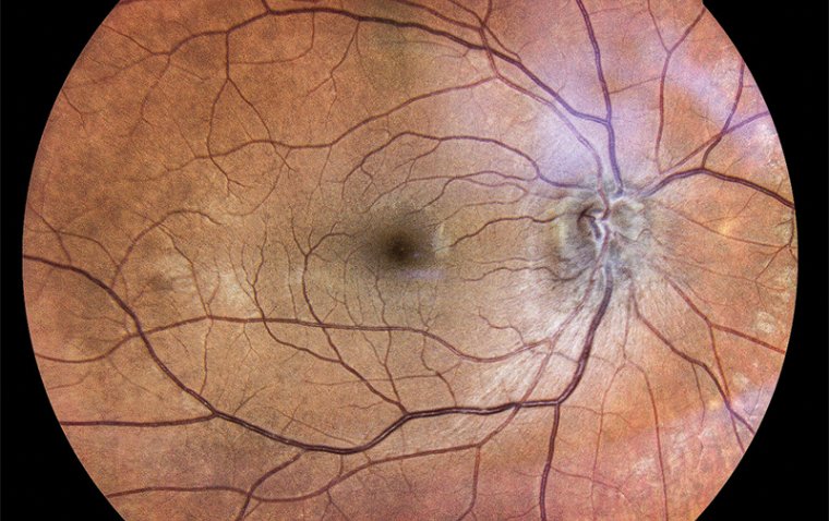 Shedding Light on Optic Neuritis: Causes and Treatments