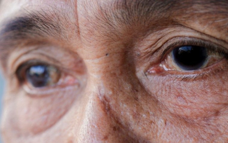 Vision Loss May Indicate Higher Risk of Dementia, Study Shows