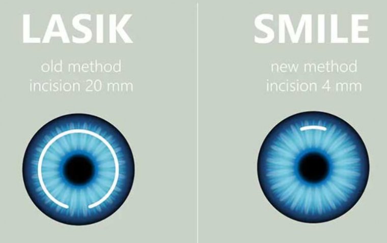 SMILE vs LASIK: Which Option is Right for You? 