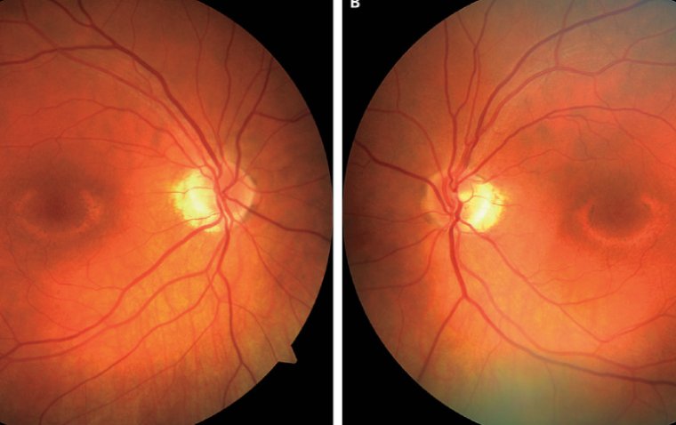 Spotlight on Bull's Eye Maculopathy: What You Need to Know